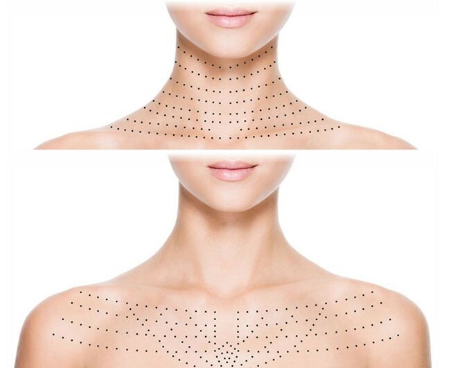 Marking for rejuvenating biorevitalization on neck & décolleté skin
