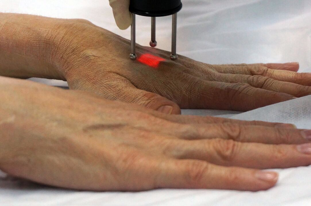 Laser rejuvenation of hands by non-ablation method