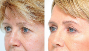 Blepharoplasty — before and after