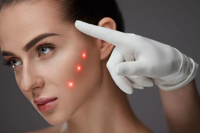 Laser rejuvenating the skin