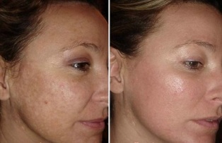 Laser facial skin rejuvenation before and after taking photos
